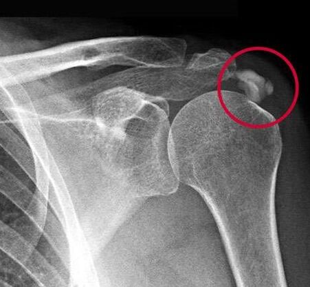 Las radiografías mostraron depósitos de sales de calcio en la articulación. 