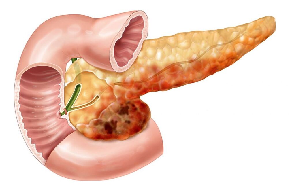 Dolor de espalda debido a pancreatitis.