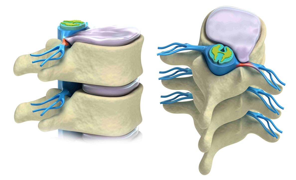 disco intervertebral dañado