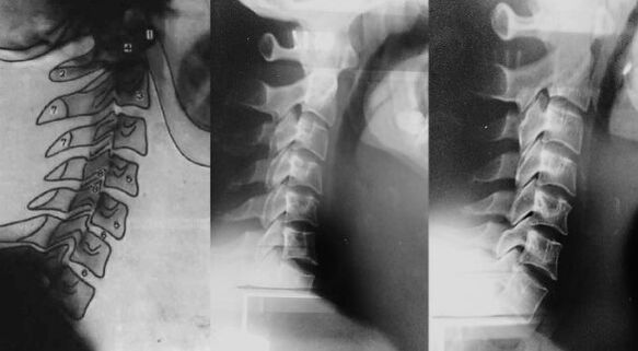 Cuello con un cambio de las primeras vértebras cervicales