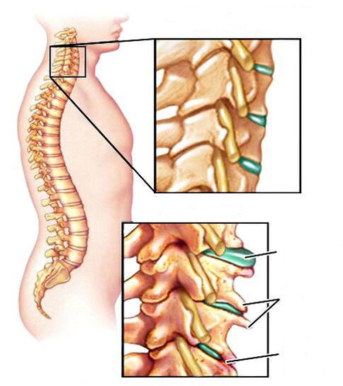 Cómo se ve la osteocondrosis